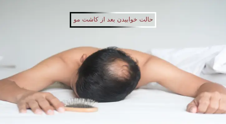توصیه‌هایی در مورد حالت خوابیدن بعد از کاشت مو